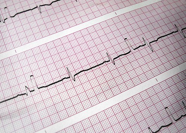 black lines, indicating elements of heart beats, on red and white graph paper.